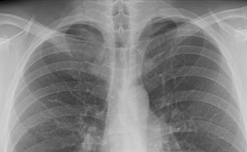 xray-lungs