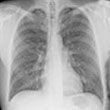 lung-x-ray