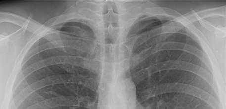 xray-lungs