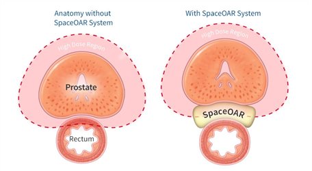 SpaceOAR