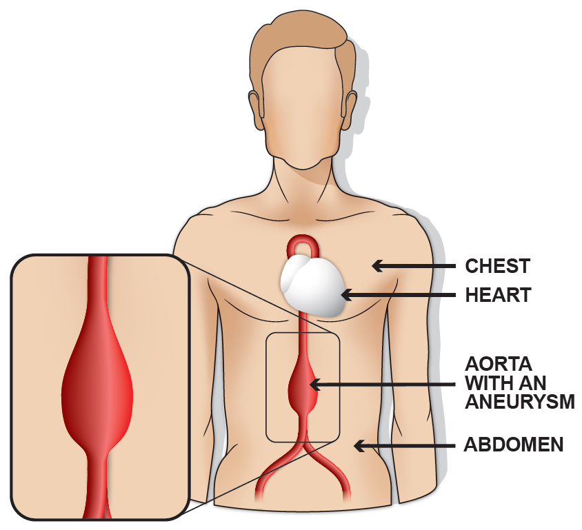 Diagram of an abdominal aorta with an aneurysm