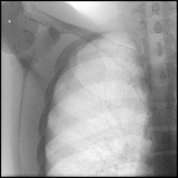 Needle imaged using a theatre mobile c-arm x-ray machine