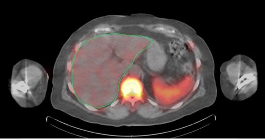 A SPECT/CT image showing liver, spleen, and bone marrow uptake of labelled antibody. See caption for full details.
