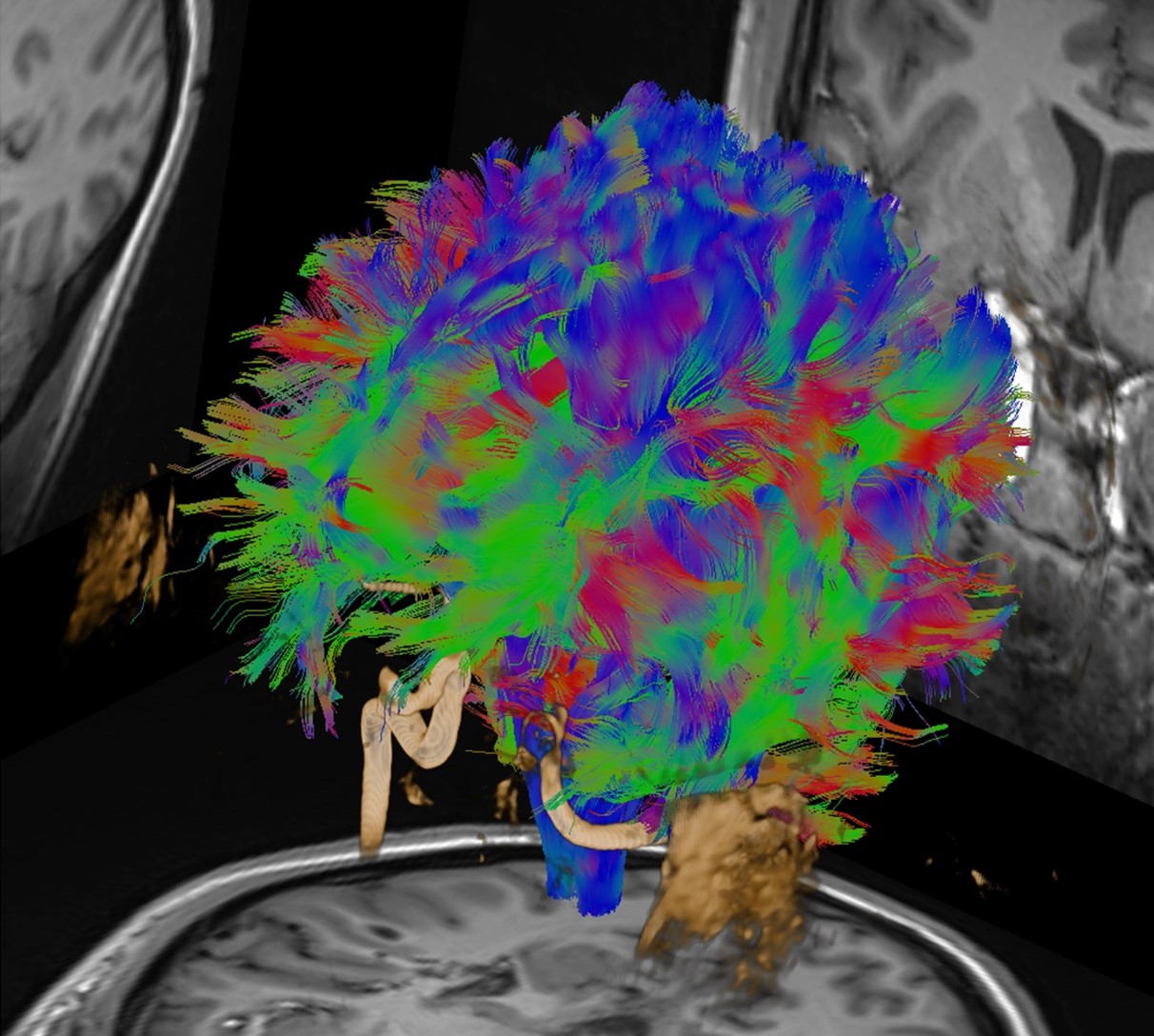 DTI for neurosurgical planning