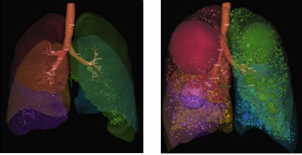 Left: Healthy subject - very little emphysema. Right: Moderate COPD subject - significant emphysema, particularly in upper lobes. Sphere size indicates interconnectivity of disease