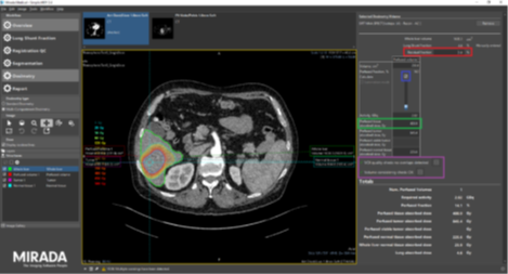 Scan showing Y90 SIRT dosimetry for a liver tumour in the right lobe