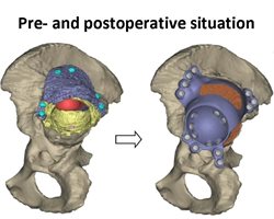 pre- and post op hip