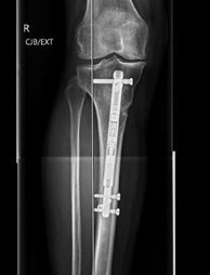 Post-op scan - weight has shifted to the other side represented by line on the left