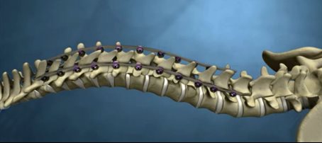 Spine with rails