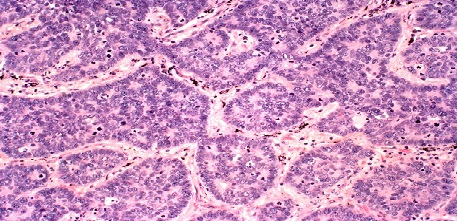 Large cell neuroendocrine