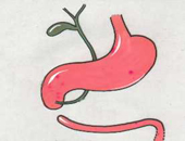 Duodenal Atresia