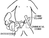 Gastroschisis