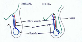 Hernia in boys