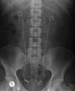 Bilateral stones stent